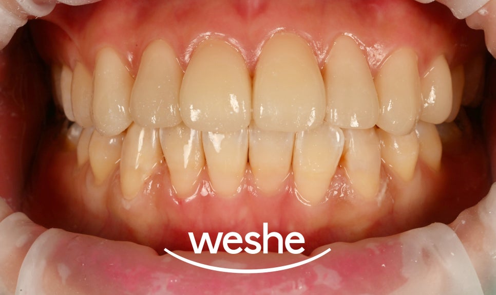 얼룩덜룩한 치아, 단순 착색, 변색일까요? 강서구 치과 법랑질 저형성증 치료법 소개글 관련 이미지 11