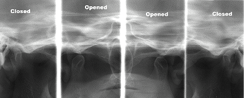 마곡동 치과 정밀 구강 진단을 위한 엑스레이(X-ray) 촬영 필요성과 원리 관련 이미지 5