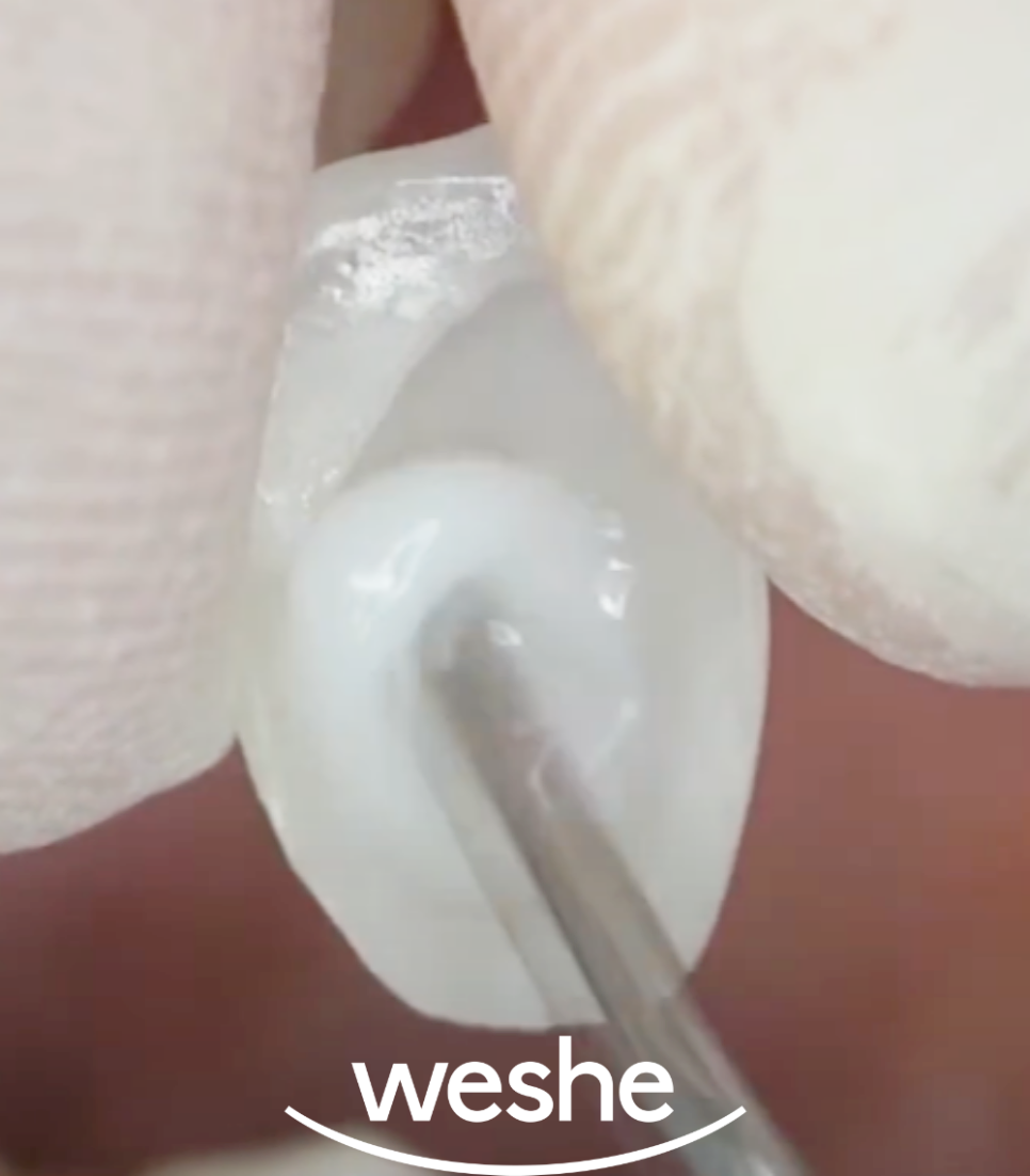 강서구 치과 웃을 때 앞니가 이상해 보인다면? 라미네이트 치료 로 자신감을 되찾으세요 관련 이미지 4