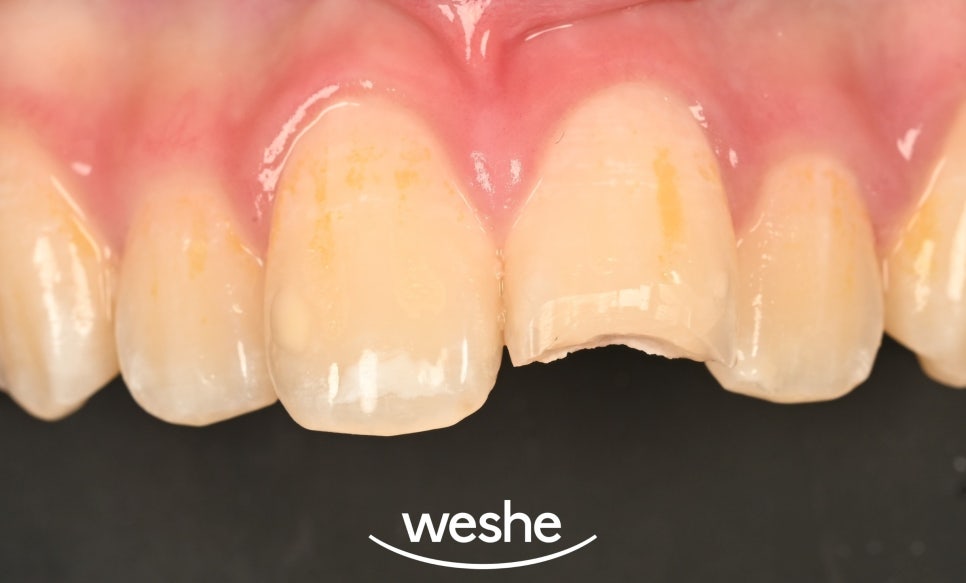 마곡동 치과 치아 파절 로 인한 레진 치료, 어떤 경우에 가능할까요? 관련 이미지 2