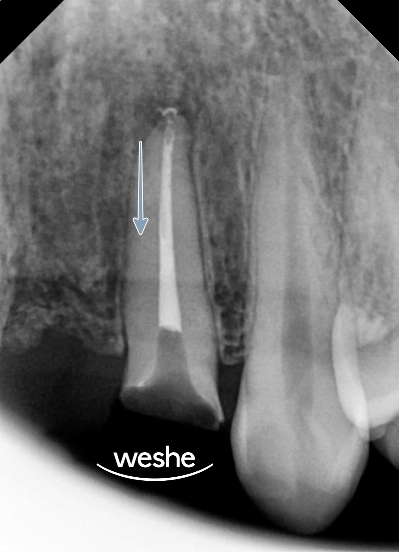 마곡역 치과 잇몸 아래 부러진 치아, 발치 없이 살릴 수 있는 방법은? 교정적 정출술을 동반한 신경치료 관련 이미지 5