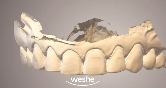 앞니 끝 깨짐 발산 치과 치아 라미네이트 치료 과정 관련 이미지 6