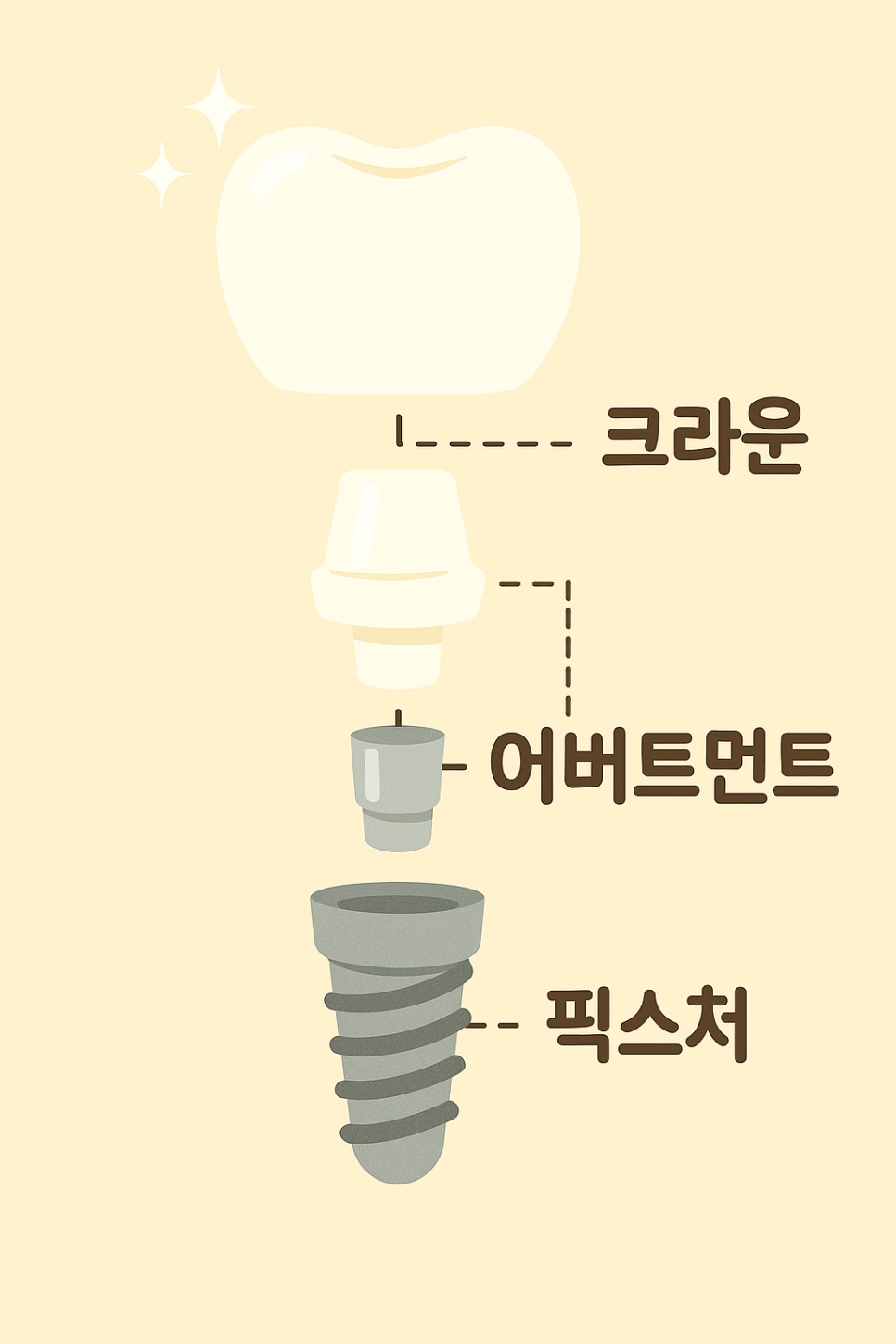 연세위시치과 여상호 대표원장이 알려주는 임플란트 시술 방법부터 과정, 전후 관리 관련 이미지 2