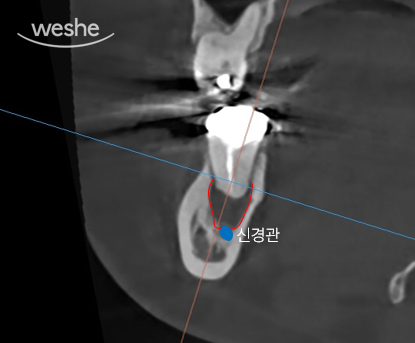 마곡역치과 치아, 진짜 뽑아야 되는 걸까요? 치아재식술이란? 관련 이미지 4