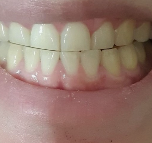 Can Teeth Break Because of Teeth Grinding? Magongnaru Station Dental Clinic image 5