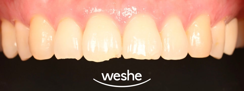 송정역 치과 앞니 치아 끝 살짝 깨짐, 레진 으로 당일 치료 가능한가요? 원인과 진료 방법 관련 이미지 2