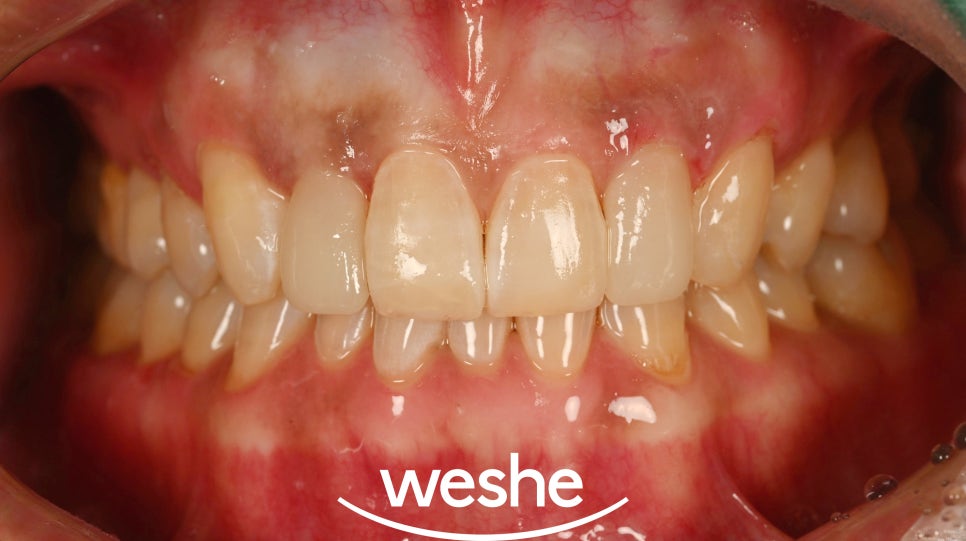 유독 작은 치아 어떻게 해결할 수 있나요? 마곡역 치과 앞니 왜소치 라미네이트 치료 과정 관련 이미지 6