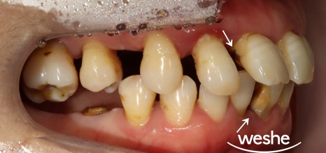 벌어진 치아 사이 (치간이개) 와 치주질환 이 동시에 있을 때, 송정역 치과 임플란트 치료 설명글 관련 이미지 3