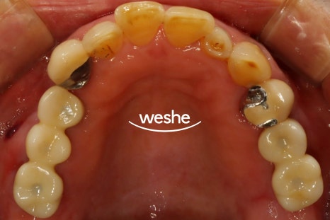 강서구 치과 어금니 임플란트 가용골 부족할 때 네비게이션 1차 2차 수술 로 해결하는 방법 관련 이미지 9
