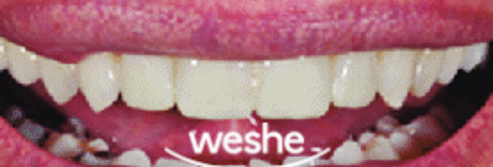 발산 치과 왜소치 치료, 레진과 치아 라미네이트 중 어떤 것이 좋을까? 진료 방법 차이와 보철 수복 과정 관련 이미지 5