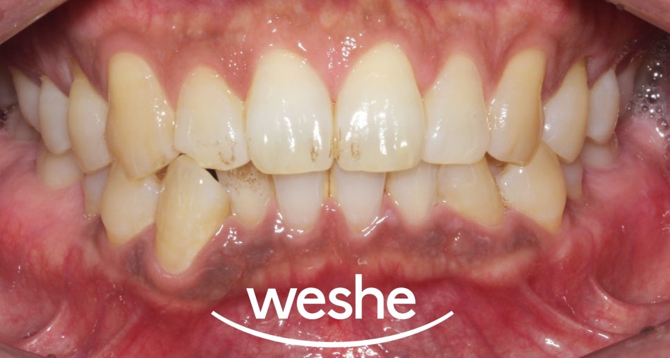 마곡역 치과 에어플로우, 연 1회 스케일링 을 아직 받지 않으셨나요? 연말 전 꼭! 받아야 되는 이유를 설명해 드리겠습니다. 관련 이미지 1