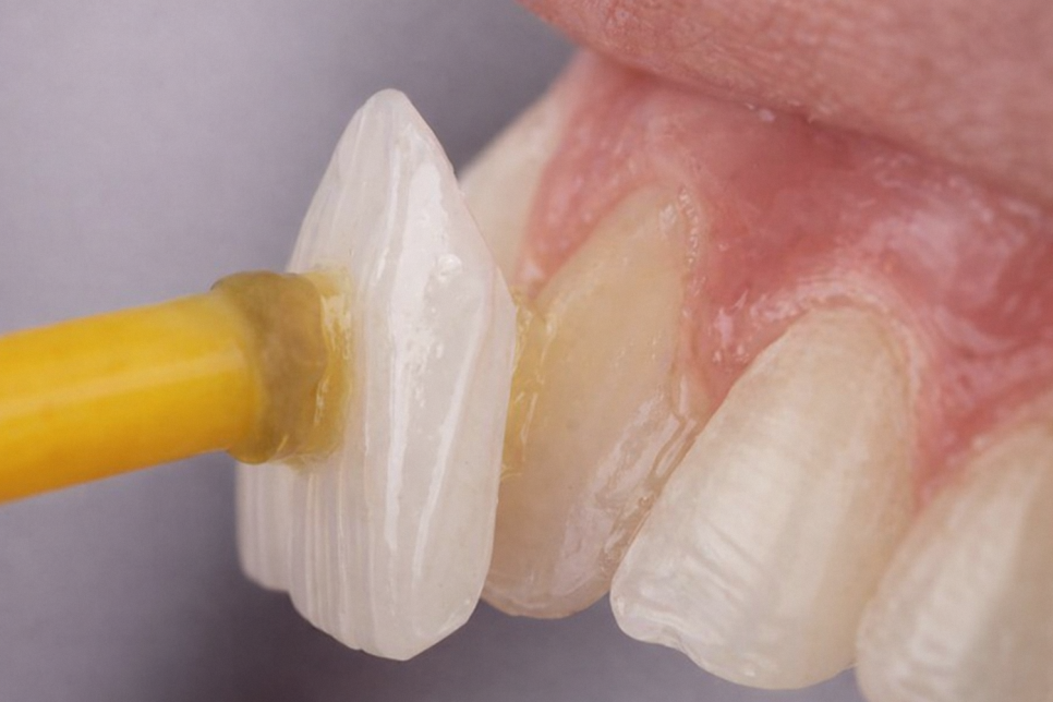 강서구 치과 앞니 사이 벌어진 공간 다이아스테마를 개선하는 레진 수복, 라미네이트 이야기 관련 이미지 3