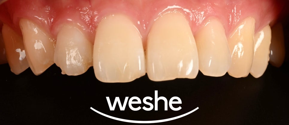 김포공항역 치과 앞니 치아 살짝 깨짐 치료 어떻게 할 수 있을까? 레진 수복 케이스 관련 이미지 1