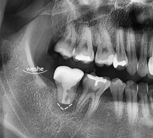 마곡 치과 어금니 통증 발치를 해야 될까? 그 전에 알아야 될 치아 재식술 관련 이미지 3