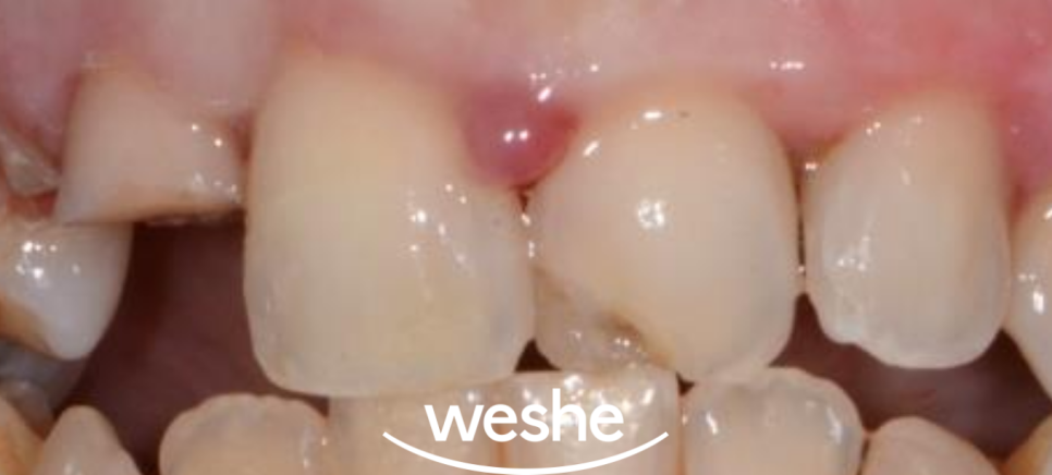 앞니 치아 파절 과 잇몸 염증, 마곡동 치과 의 라미네이트 보철 치료 과정 관련 이미지 1