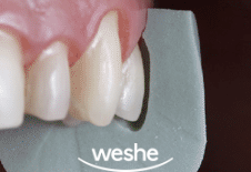 송정 치과 치아 배열이 틀어졌을 때, 앞니 라미네이트 치료 과정 관련 이미지 4