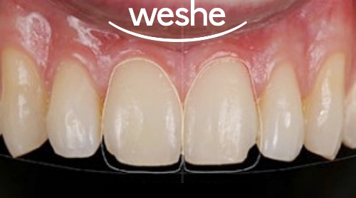 마곡 치과 앞니 깨짐! 레진으로는 부족할 때? 라미네이트(Veneer) 치료 과정 관련 이미지 3