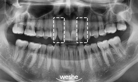 유독 작은 치아 어떻게 해결할 수 있나요? 마곡역 치과 앞니 왜소치 라미네이트 치료 과정 관련 이미지 4