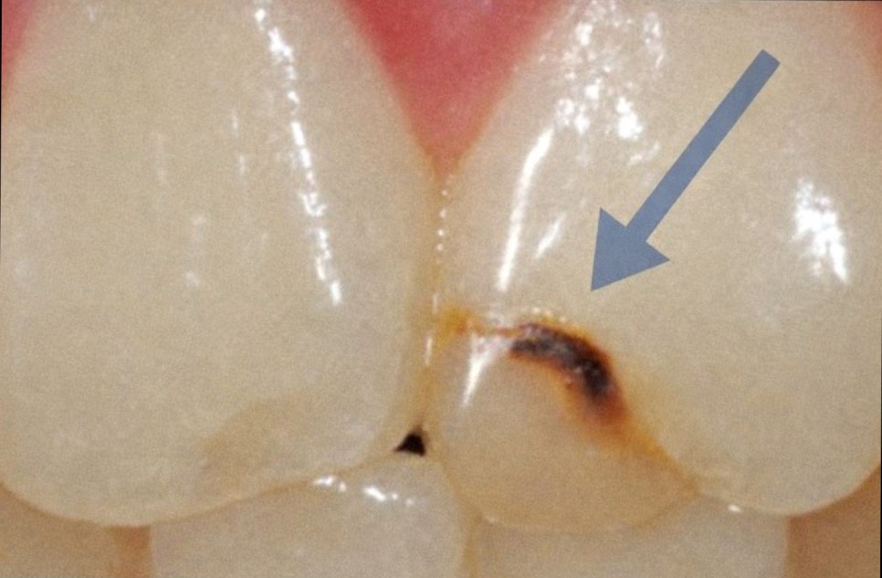 앞니 레진 변색, 티 안 나는 라미네이트 교체와 비율 개선할 수 있을까? 마곡역 치과 관련 이미지 2