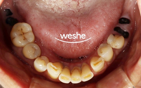 마곡역 치과 기공실과 기공소의 차이와 그에 따른 임플란트 진료 과정 관련 이미지 8