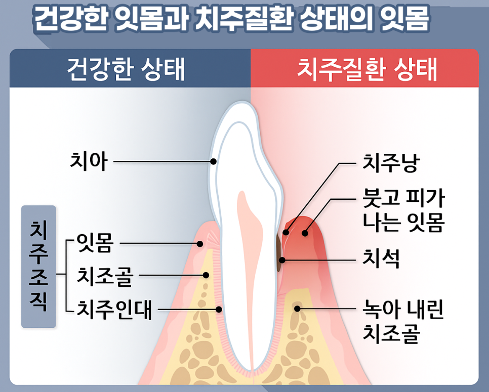 마곡동 치과 치주질환으로 인한 치아 벌어짐, 그리고 임플란트 치료 과정 관련 이미지 2