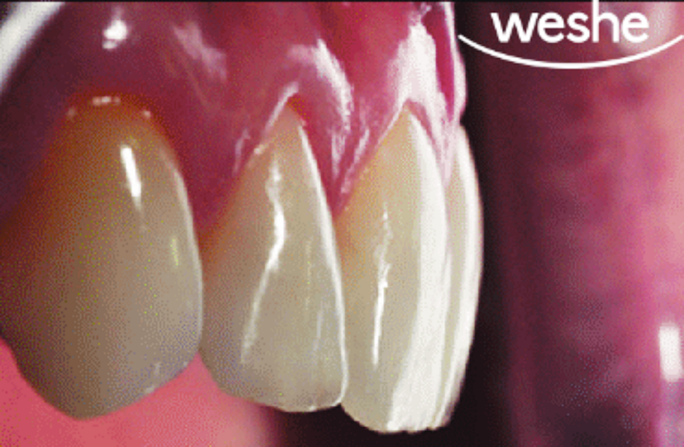 발산 치과 왜소치 치료, 레진과 치아 라미네이트 중 어떤 것이 좋을까? 진료 방법 차이와 보철 수복 과정 관련 이미지 4