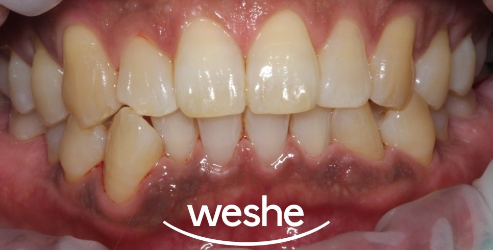 마곡역 치과 에어플로우, 연 1회 스케일링 을 아직 받지 않으셨나요? 연말 전 꼭! 받아야 되는 이유를 설명해 드리겠습니다. 관련 이미지 4