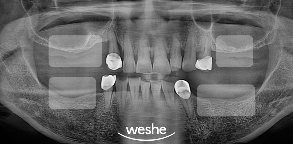 강서구 치과 어금니 임플란트 가용골 부족할 때 네비게이션 1차 2차 수술 로 해결하는 방법 관련 이미지 6