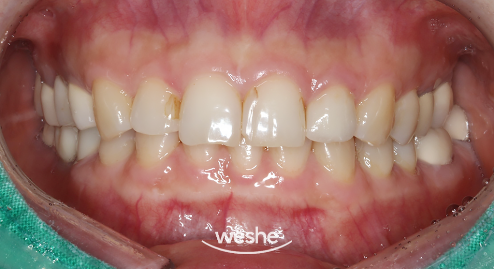 마곡동 치과 라미네이트 앞니 미세 파절, 변색 치료 사례 분석정리 관련 이미지 1