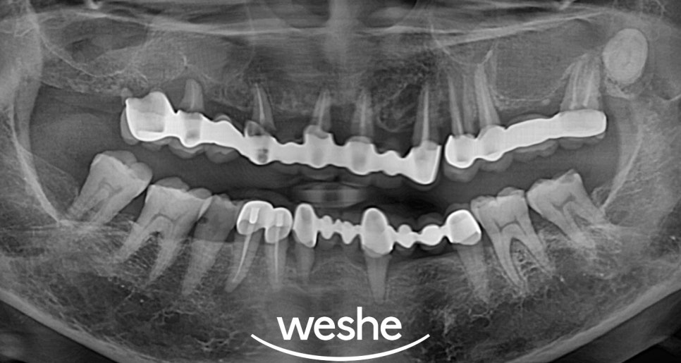 위턱 전체 임플란트 마곡동 치과 수면치료(의식하진정법)을 활용한 진료 방법 관련 이미지 5