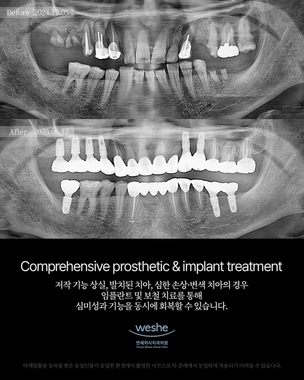 ✨ Comprehensive prosthetic & implant treatment - 종합 보철 치료와 임플란트 수술 전후 ✨ 관련 이미지 1