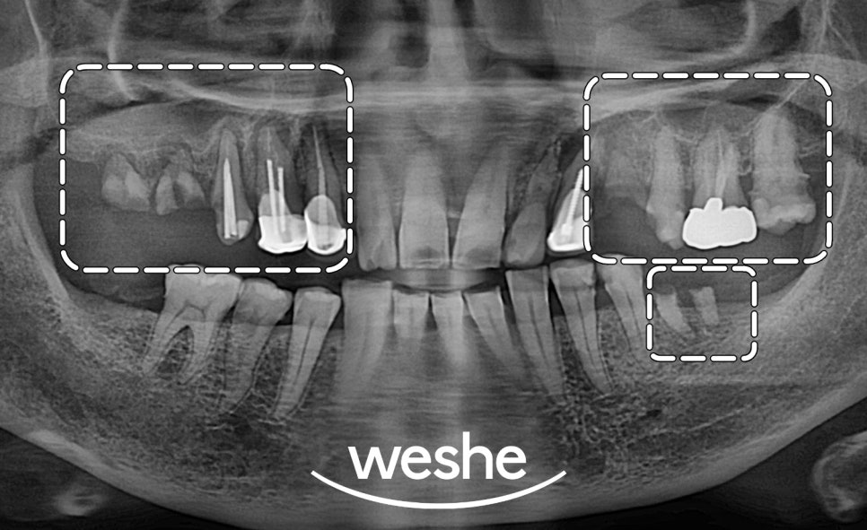 마곡역 치과 기공실과 기공소의 차이와 그에 따른 임플란트 진료 과정 관련 이미지 9
