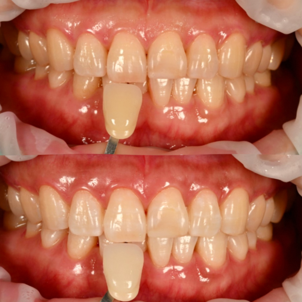 강서구 마곡 치과 벚꽃 시즌 전에 챙기는 심미치료 세 가지 관련 이미지 3