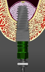 마곡역 치과 임플란트 식립 수술 시 필요한 상악동 거상술 종류 관련 이미지 3