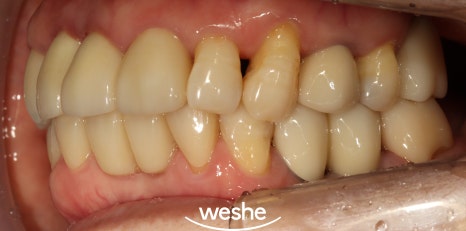 벌어진 치아 사이 (치간이개) 와 치주질환 이 동시에 있을 때, 송정역 치과 임플란트 치료 설명글 관련 이미지 14