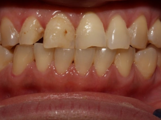 Can Teeth Break Because of Teeth Grinding? Magongnaru Station Dental Clinic image 6