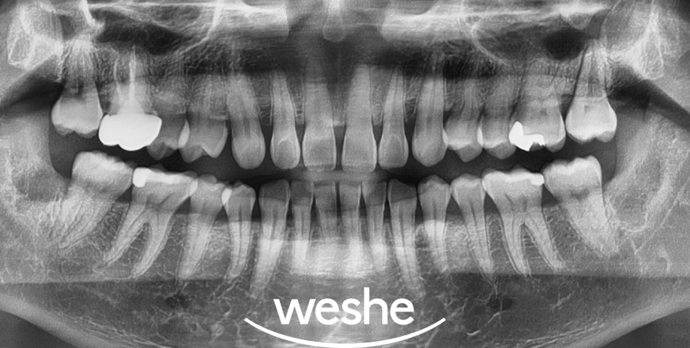 헛구역질(gagging reflex) 때문에 포기했던 구강진료, 해결할 수 있는 방법은? 마곡 수면치과 사랑니발치, 원데이 인레이, 치주치료 관련 이미지 5