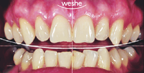 발산 치과 왜소치 치료, 레진과 치아 라미네이트 중 어떤 것이 좋을까? 진료 방법 차이와 보철 수복 과정 관련 이미지 1