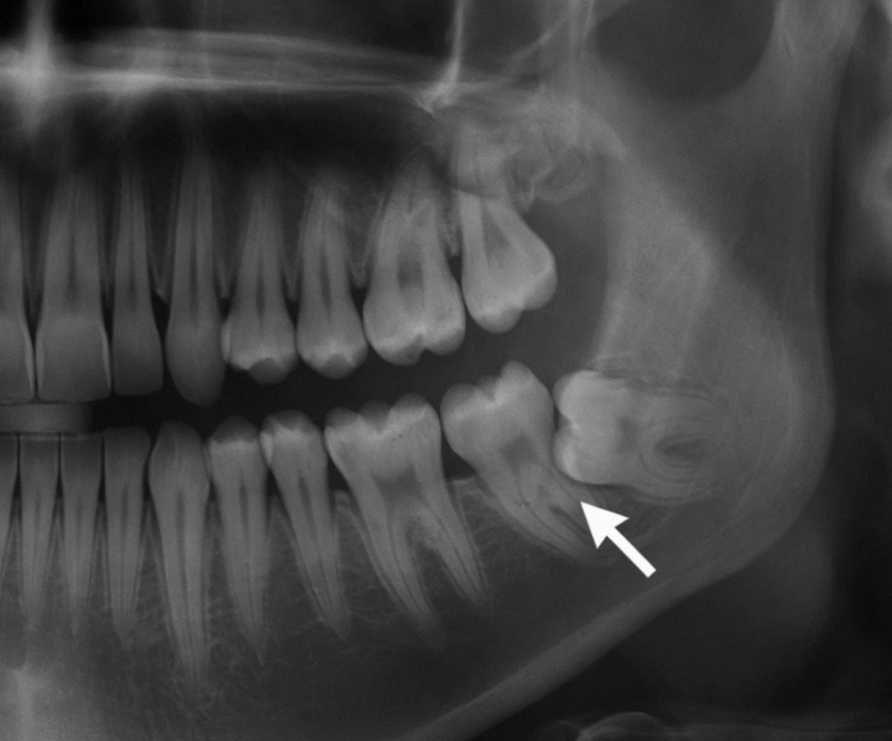 마곡동 치과 누운 매복 사랑니 발치, 신경과 가까울수록 구강악안면외과 전문의가 필요한 이유 관련 이미지 1