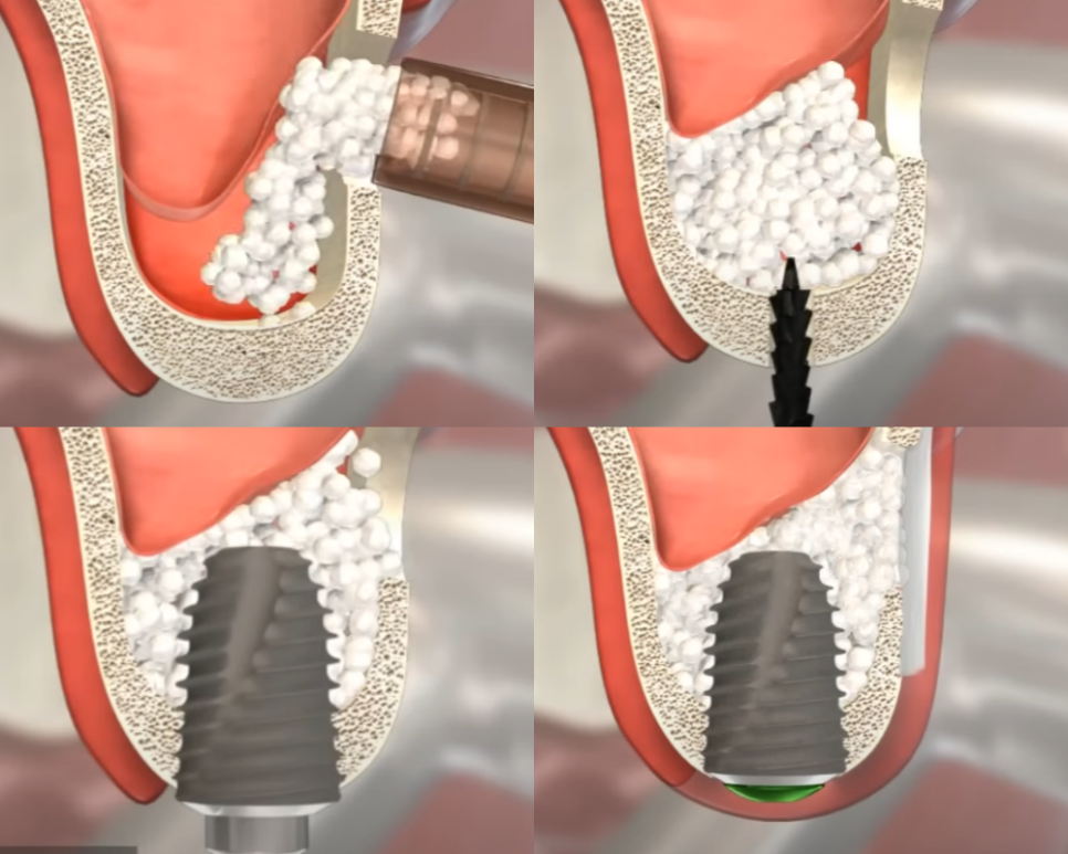 마곡역 치과 임플란트 식립 수술 시 필요한 상악동 거상술 종류 관련 이미지 5