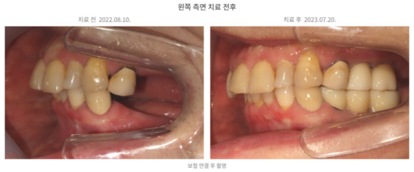 위 어금니 잇몸뼈가 부족하다면? 상악동 거상술이 필요한 이유 관련 이미지 6