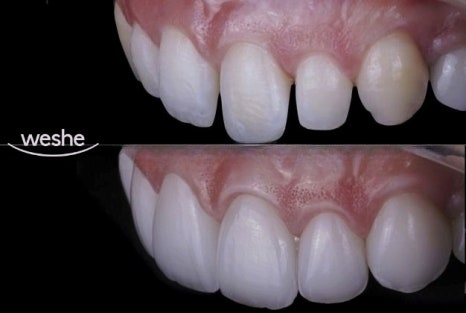 😁 웃을 때 치아 사이 가 벌어져 보인다면? 마곡동 치과 라미네이트 로 해결! 관련 이미지 12