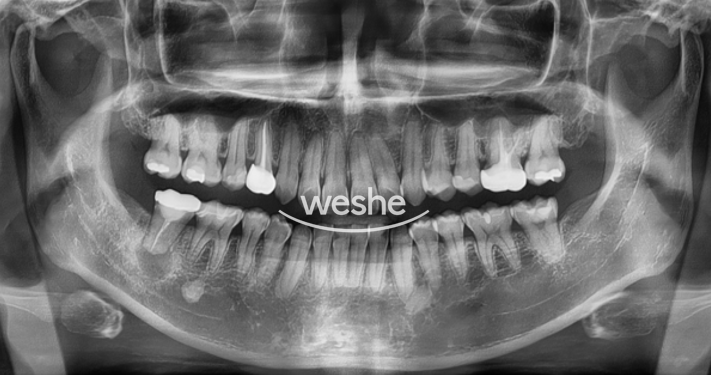 마곡역치과 치아, 진짜 뽑아야 되는 걸까요? 치아재식술이란? 관련 이미지 2