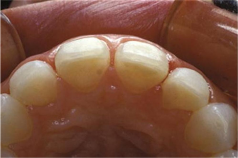 송정 치과 앞니 레진 변색 제거 후 전치부 치아 라미네이트 과정 관련 이미지 4