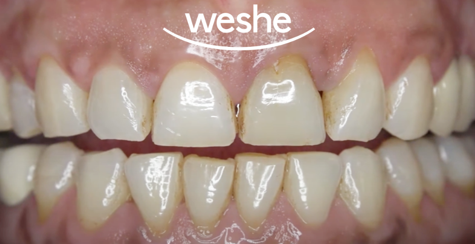 강서구 치과 웃을 때 앞니가 이상해 보인다면? 라미네이트 치료 로 자신감을 되찾으세요 관련 이미지 1