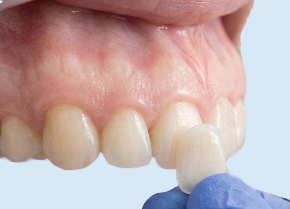 발산 치과 3월, 새 출발 앞두고치아 컴플렉스가 신경 쓰이신다면? 관련 이미지 4