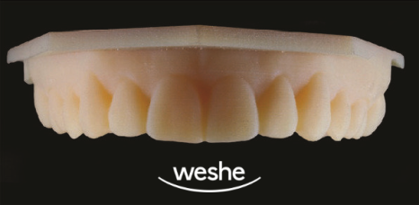 앞니 끝 깨짐 발산 치과 치아 라미네이트 치료 과정 관련 이미지 4