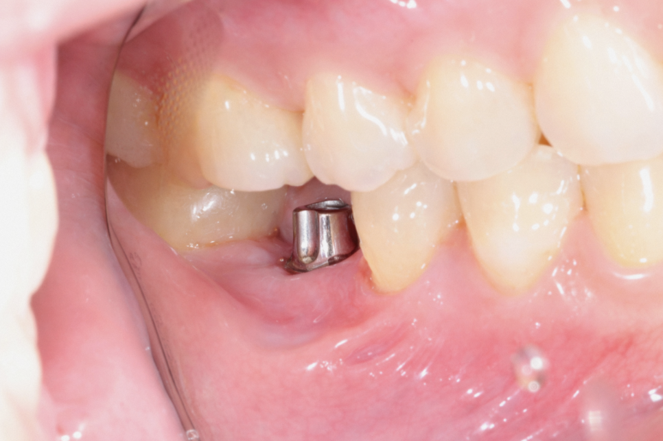 Gangseo-gu Dental Clinic: Have you given up on implants because of blood sugar or blood pressure? Reasons you should read this and think again image 4