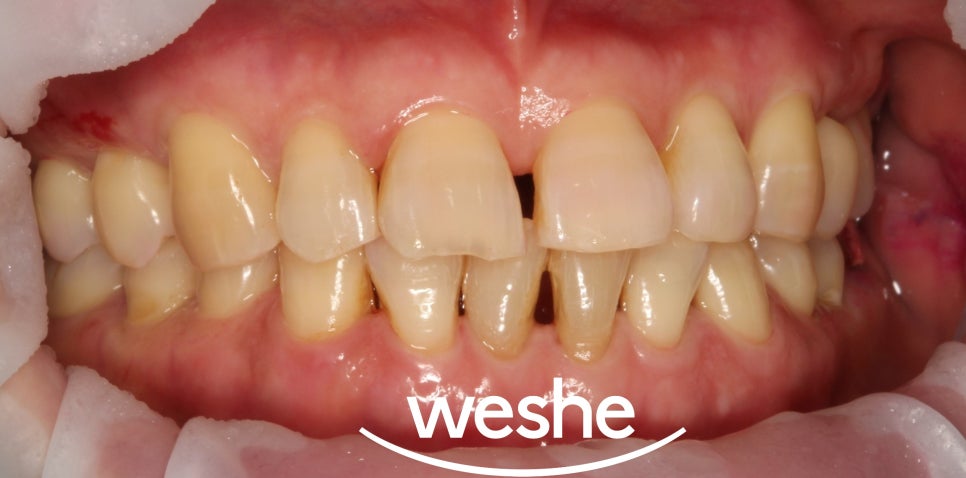 앞니 벌어진 틈, 자연스럽게 해결하는 방법은? 라미네이트 치료 과정을 송정역 치과 에서 소개해 드리도록 하겠습니다. 관련 이미지 4