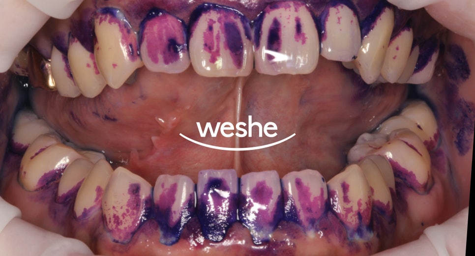 발산 치과 에어플로우 스케일러 를 활용한 치석제거 과정 관련 이미지 6